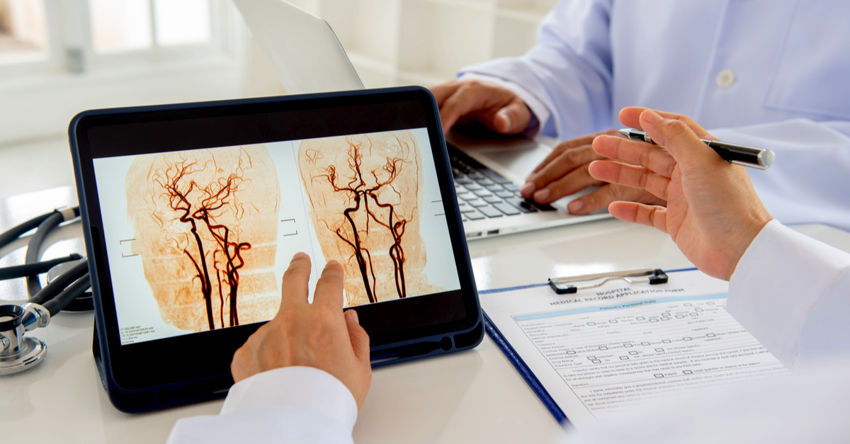 Stroke Misdiagnosis and Medical Malpractice | Misdiagnosed Stroke Law Firm